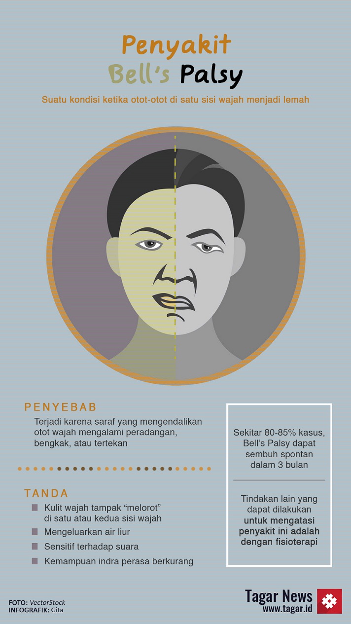 Bell's Palsy