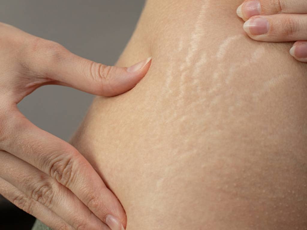 Cara Menghilangkan Stretch Mark