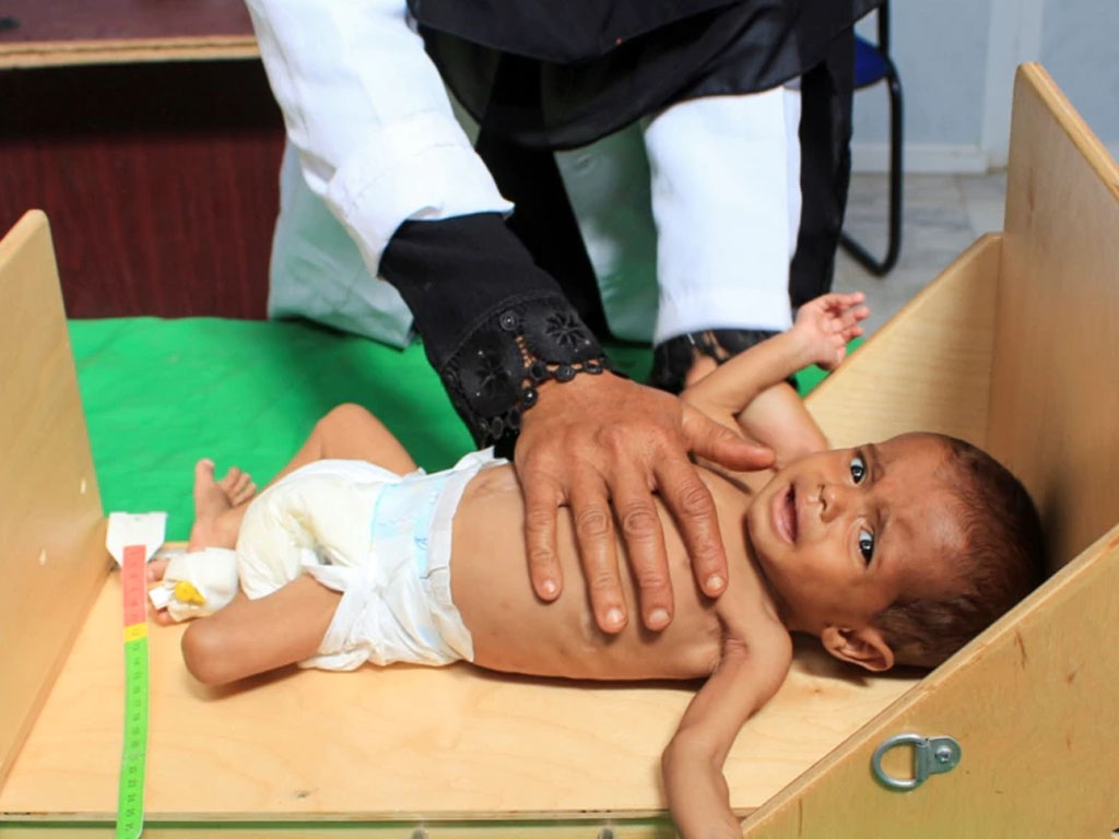 bayi malanutrisi di yaman