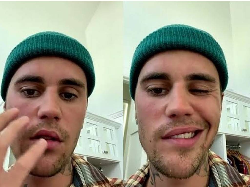 Justin Bieber Indap Ramsay Hunt Syndrome