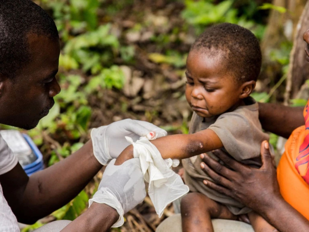 Seorang anak di afrika  terinfeksi cacar monyet