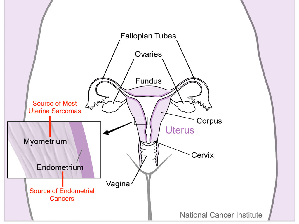 kanker endometrium