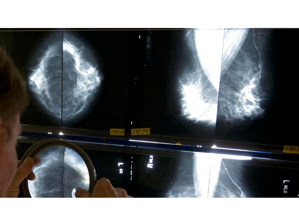 ahli radiologi periksa mammogram di AS