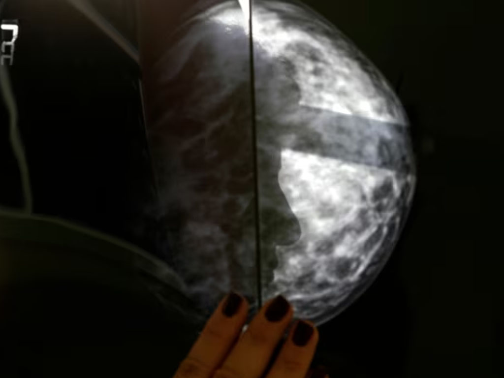 pasien kanker payudara di yunani