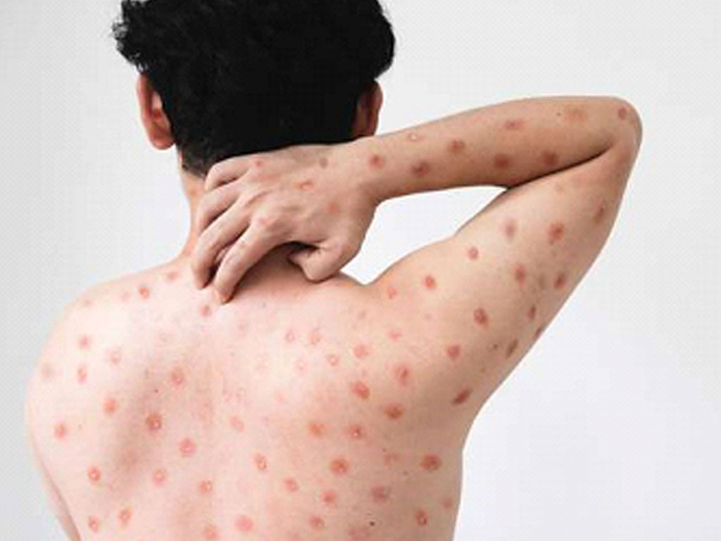 ilustrasi mpox2