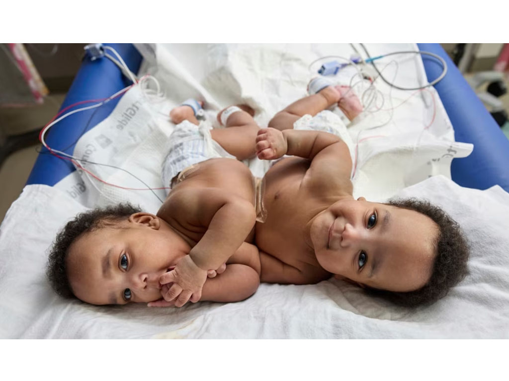 bayi kebar siam di Philadelphia