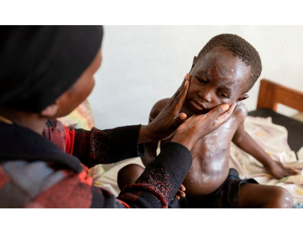 wabah Mpox di Kongo