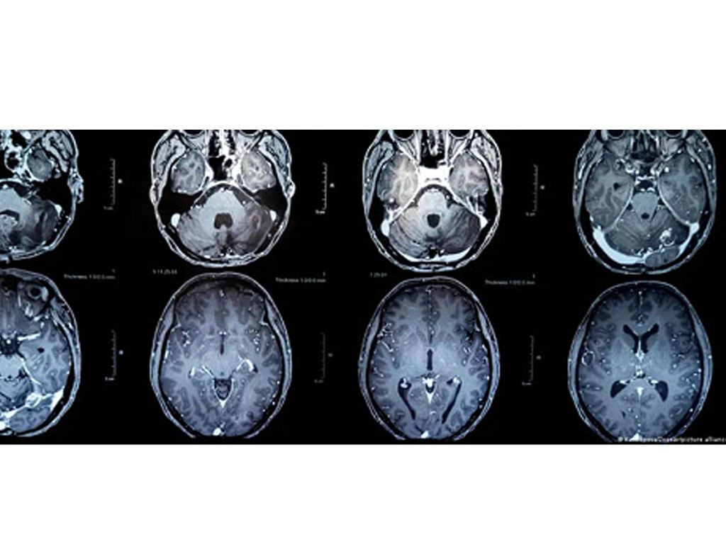 tumor otak